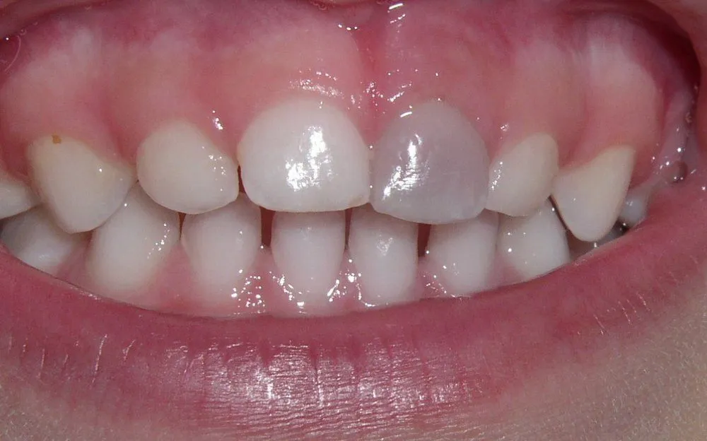 Roxane Boiteau 07-01-11 Tooth F Discolored
