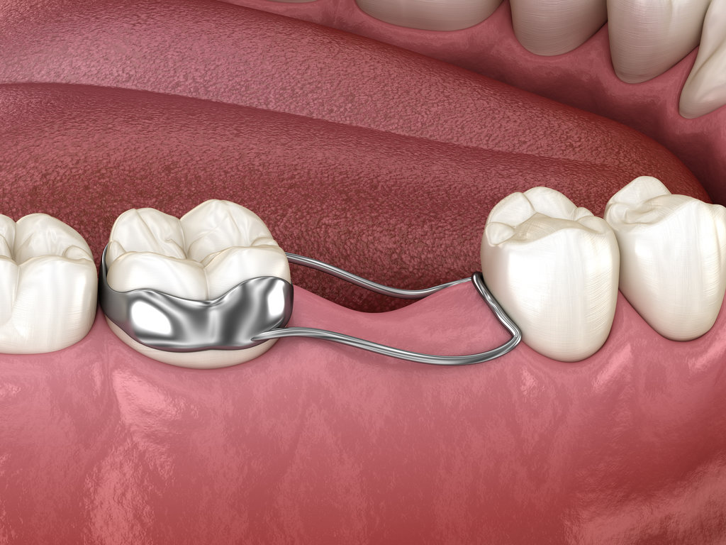 Space Maintainer Unilateral keeps from teeth shift deformatiuon after losing molar tooth. 3D illustration