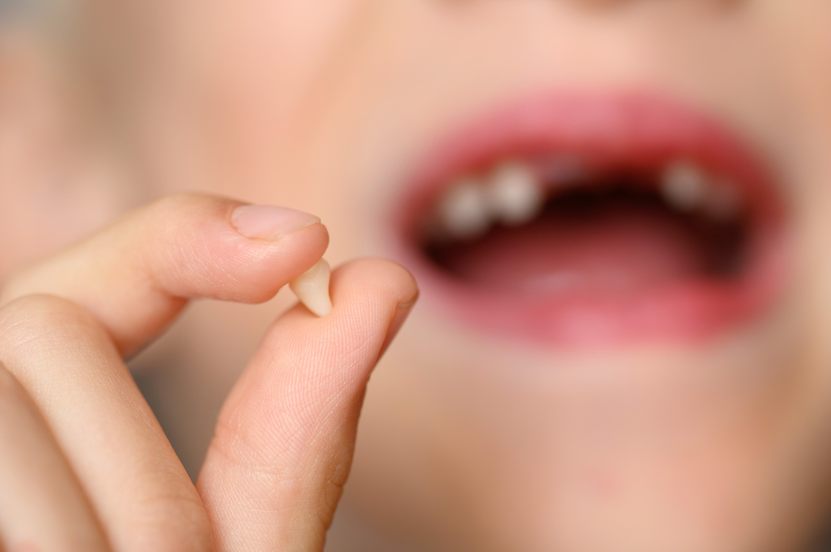 Child holding fallen baby tooth in hand against background of mouth with smile with missing teeth, close-up. Changing baby teeth. Concept of children's dental care and dental health
