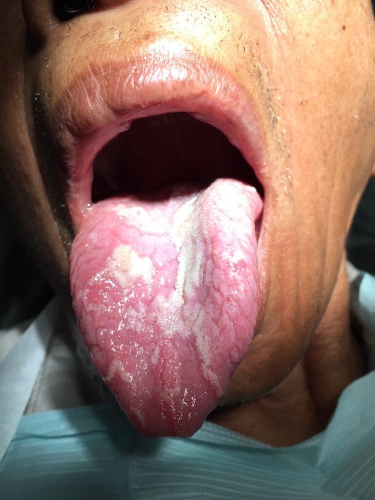 Asymmetrical White Patches and Erythema on the Dorsal Tongue