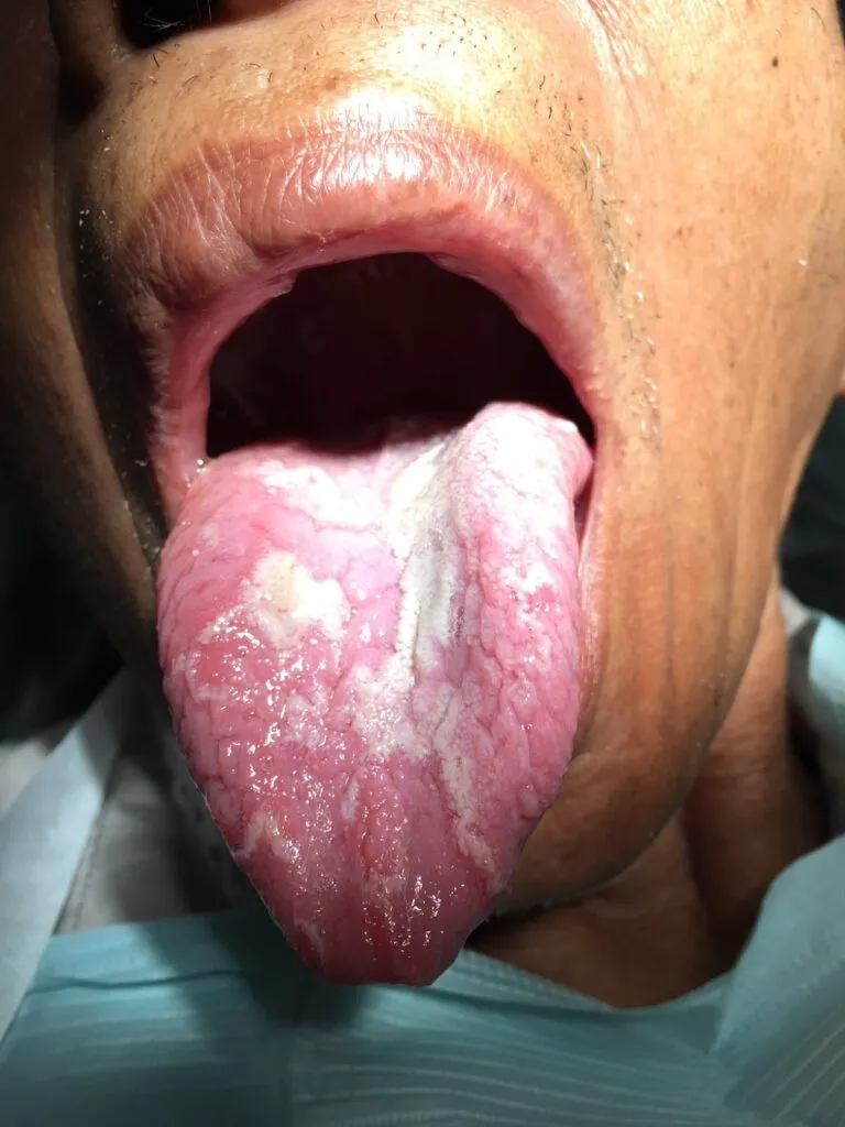 Asymmetrical White Patches and Erythema on the Dorsal Tongue