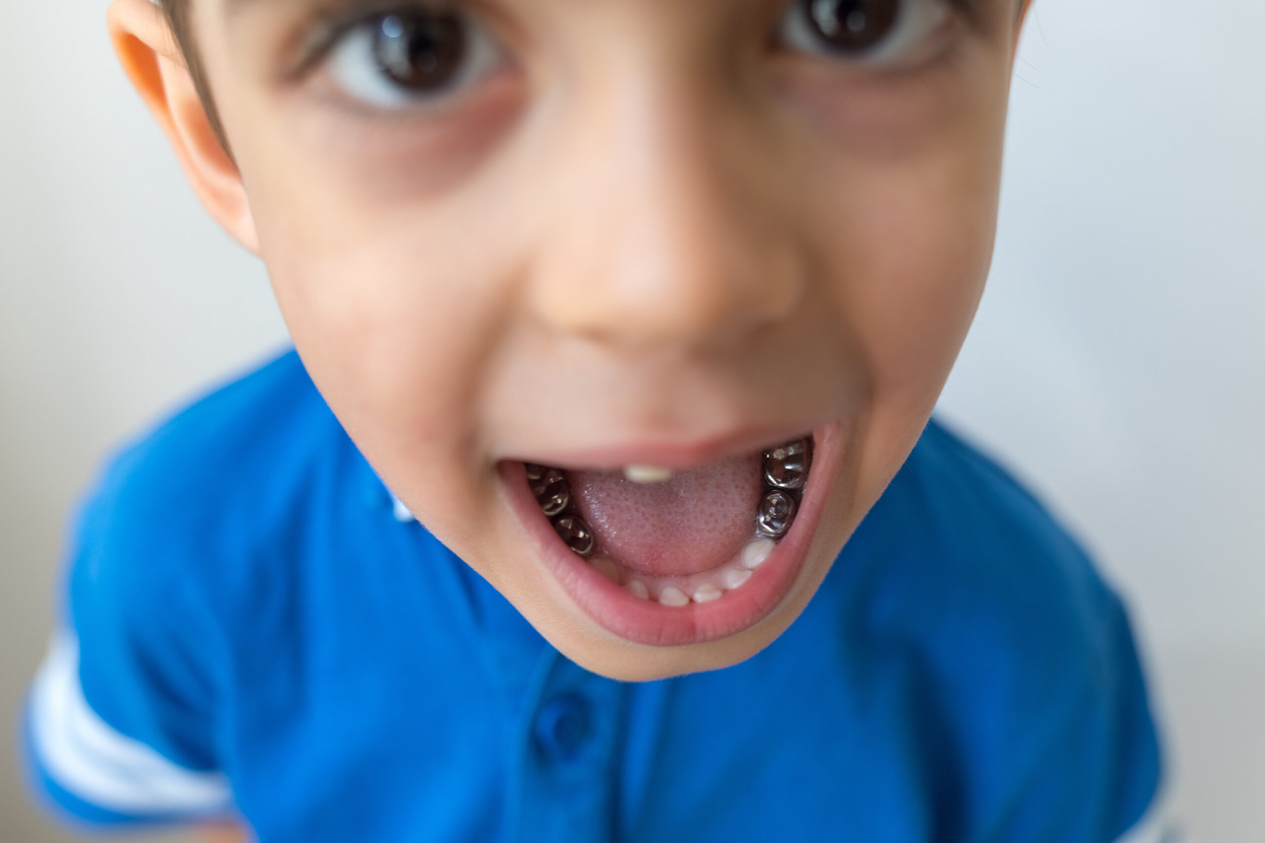 Stainless steel dental crown used to restore a child's tooth